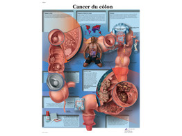 POSTER CANCER DU COLON - VR2432L