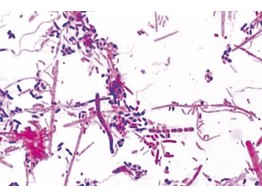 Bacteries du depot dentaire. Flore buccale montrant des bacteries Gram positives et negatives
