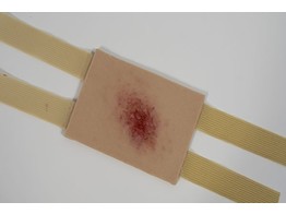 BLESSURE DE FEU PORTABLE