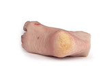 WOUNDED FOOT WITH DIABETIC FOOT SYNDROME  ADVANCED STAGE