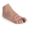 WOUNDED FOOT WITH DIABETIC FOOT SYNDROME