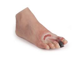 PIED BLESSE AVEC SYNDROME DU PIED DIABETIQUE
