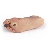 WOUNDED FOOT WITH DIABETIC FOOT SYNDROME
