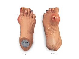 MODEL -ADVANCED FOOT PROBLEMS