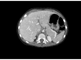 FANTOME ABDOMINAL POUR CT  RADIOGRAPHIE ET RADIOTHERAPIE br/  - ENFANT