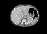 ABDOMINAL PHANTOM FOR CT  X-RAY AND RADIOTHERAPY br/  - CHILD