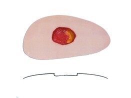 RED WOUND MODEL B- LARGE