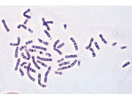 Human chromosomes in smear from culture of blood  female