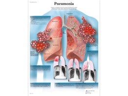 POSTER PNEUMONIA - PAPIER - ENGELS - VR1326UU