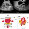 ENSEMBLE COMPLET DE MANNEQUINS POUR ECHOGRAPHIE PELVIQUE FEMININE  10 SEMAINES  - US-10C
