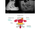 FANTOME POUR ECHOGRAPHIE PELVIENNE OBSTETRICALE  10 SEMAINES  - US-10D