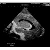 SIMULATEUR DE TETE NEONATALE POUR ECHOGRAPHIE CRANIENNE - US-14A