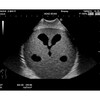ULTRASCHALL-NEONATAL-KOPF-PHANTOM  ABNORMALER TYP    US-14B