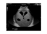 ULTRASCHALL-NEONATAL-KOPF-PHANTOM  ABNORMALER TYP    US-14B