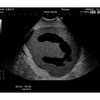 ULTRASCHALL-NEONATAL-KOPF-PHANTOM  ABNORMALER TYP    US-14B