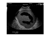 ULTRASCHALL-NEONATAL-KOPF-PHANTOM  ABNORMALER TYP    US-14B