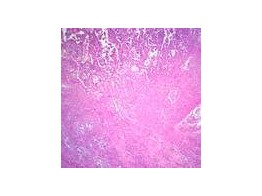 SICKLE CELL ANEMIA  SMEAR