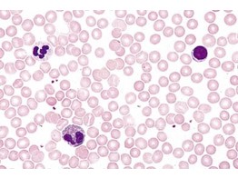 Sang humain  frottis  coloration de Giemsa. Globules rouges  hematies  non nuclees  differentes formes de globules blanc  leucocytes .