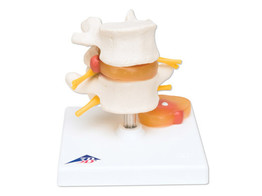 MODELE DE VERTEBRES LOMBAIRES AVEC PROLAPSUS DES DISQUES INTERVERTEBRAUX - A76  1000149 