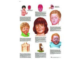 POSTER LES MALADIES INFANTILES - FRANCAIS - VR2741L